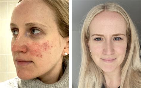 rosacea bellmore Acne & Rosacea, Cosmetic Dermatology, Dermatologic Surgery, Pediatric Dermatology 80 Beekman street South bridge plaza K, New York, NY, 10038 Hospitals: Mount Sinai HospitalRosacea is a chronic and relapsing inflammatory skin disorder that primarily involves the central face